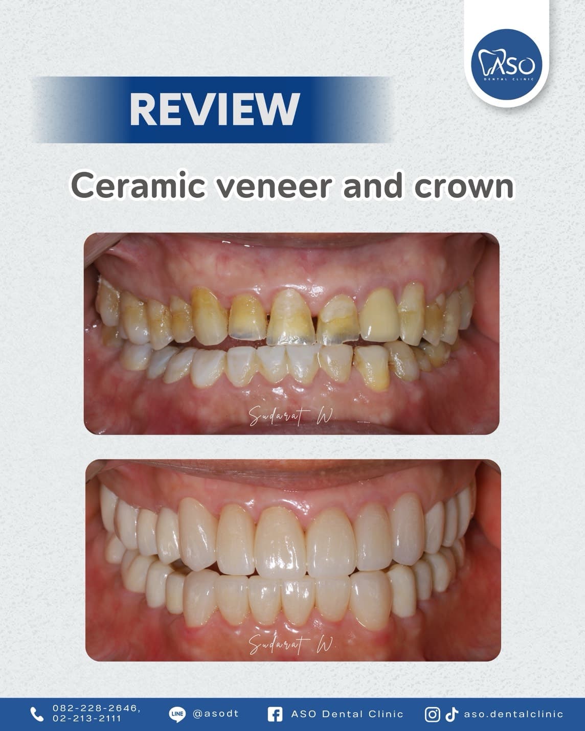 Ceramic Veneers