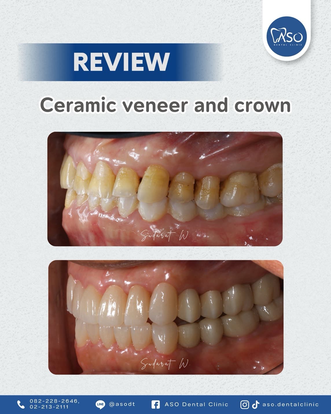 Ceramic veneer and crown side view